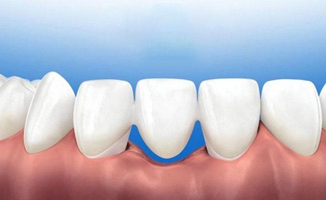 Làm cầu răng sứ có bị tiêu xương không? | Vinmec