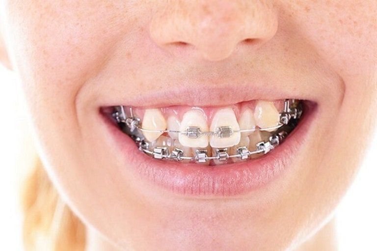 Khi niềng răng c&oacute; phải nhổ răng khểnh kh&ocirc;ng? | Vinmec