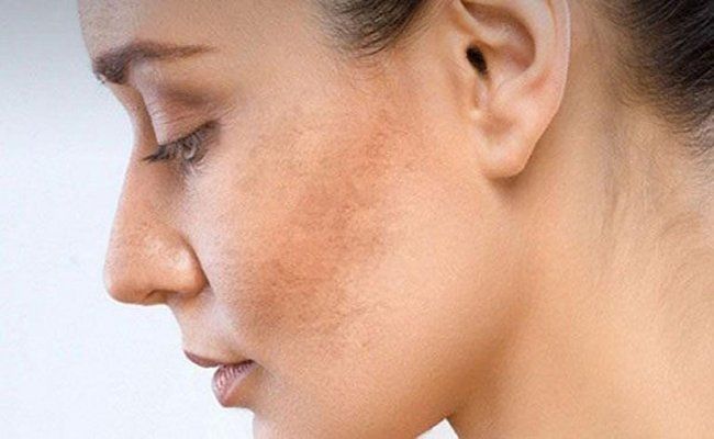 Cách tạm biệt làn da sạm xỉn màu | Vinmec