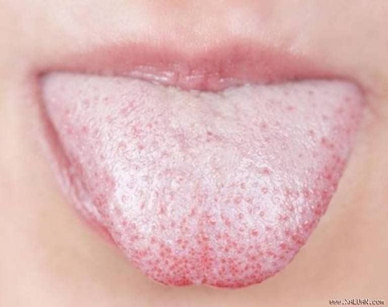 Bệnh lưỡi trắng có mùi hôi | Vinmec