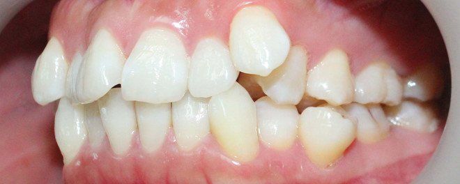 Có cách nào chỉnh răng mọc lệch không cần niềng? | Vinmec