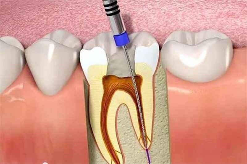 LẤY TỦY RĂNG CÓ ĐAU KHÔNG VÀ GIÁ BAO NHIÊU