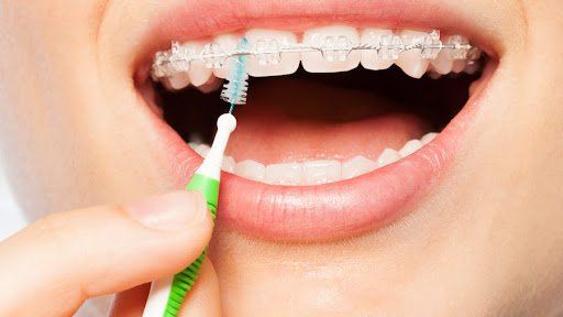 Vệ sinh răng miệng ở bệnh nhân chỉnh nha | Vinmec