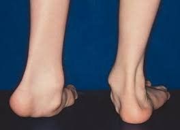 Hình ảnh minh họa dị tật mắt cá chân