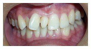 Hyperdontia