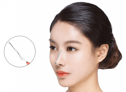 Sử dụng chỉ sinh học chất lượng cao giúp hạn chế tối đa các biến chứng sau nâng mũi