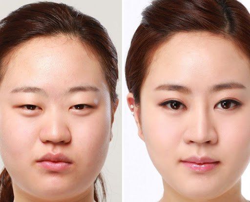 CẮT MÍ MẮT SỤP CẢI THIỆN TÌNH TRẠNG MẮT MỆT MỎI