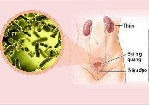 Nguyên nhân gây ra bệnh viêm đường tiết niệu là gì? Các chuyên gia cho biết, bệnh thường do vi khuẩn E.coli có trong phân gây ra.