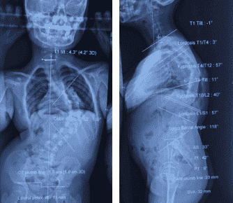 Preoperative spinal X-ray