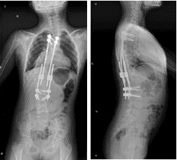 Postoperative X-ray