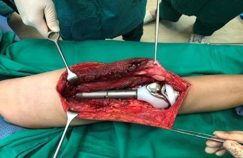 Image of distal femoral replacement with titanium device