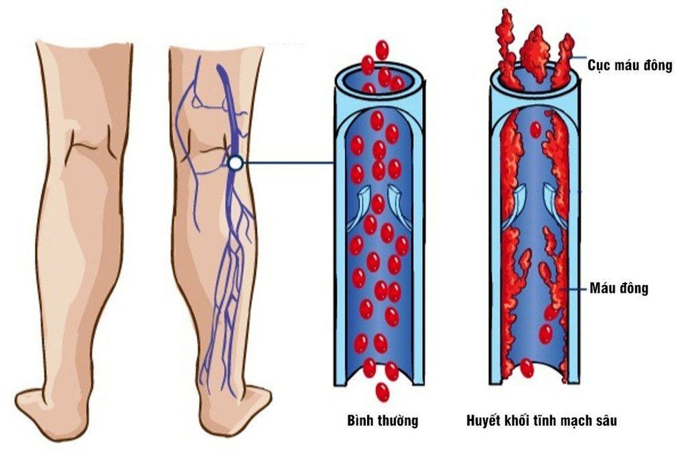 Điều trị huyết khối tĩnh mạch sâu trên bệnh nhân ung thư
