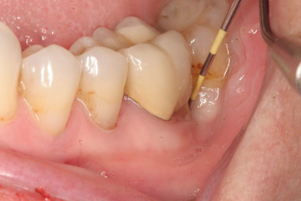 Người bệnh tiểu đường có thể bị mắc các bệnh răng miệng như viêm nha chu, sâu răng,...