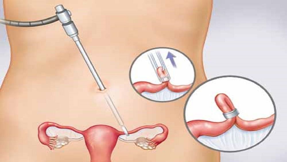 Phẫu thuật cắt buồng trứng để điều trị ung thư vú
