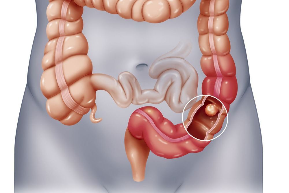 Bệnh lý tắc ruột chống chỉ định với thủ thuật nội soi ruột non bằng viên nang