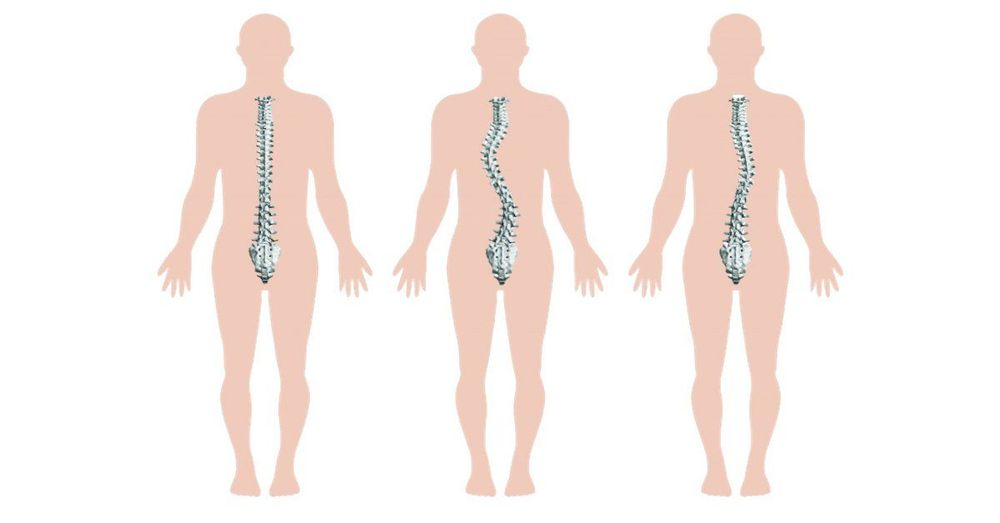 
Vẹo cột sống bẩm sinh là loại bệnh không thể phòng ngừa và cũng khá khó chữa

