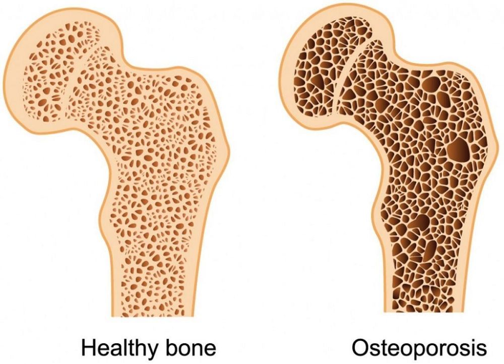 Biến chứng thường gặp của bệnh cường giáp tự miễn là loãng xương
