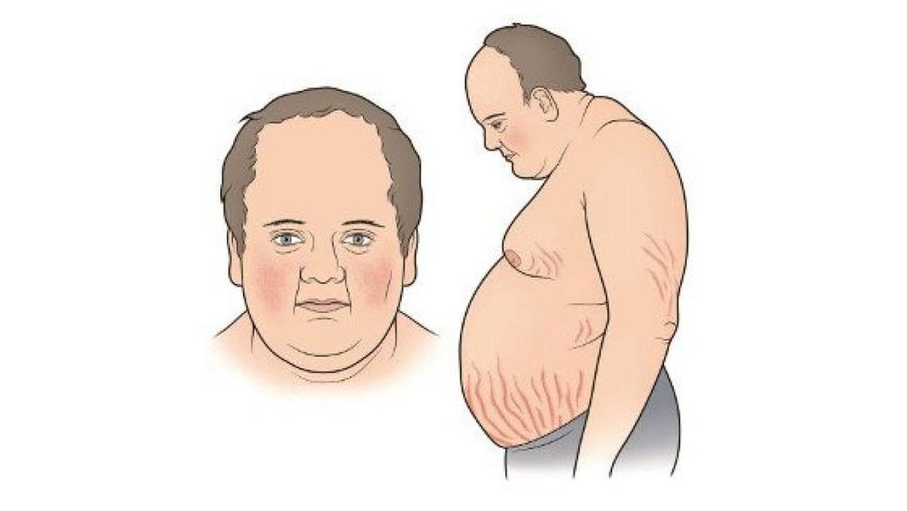 Hội chứng Cushing