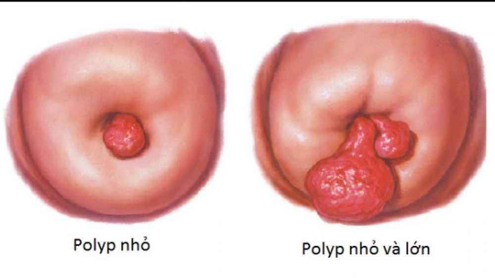 Cervical polyp visualization