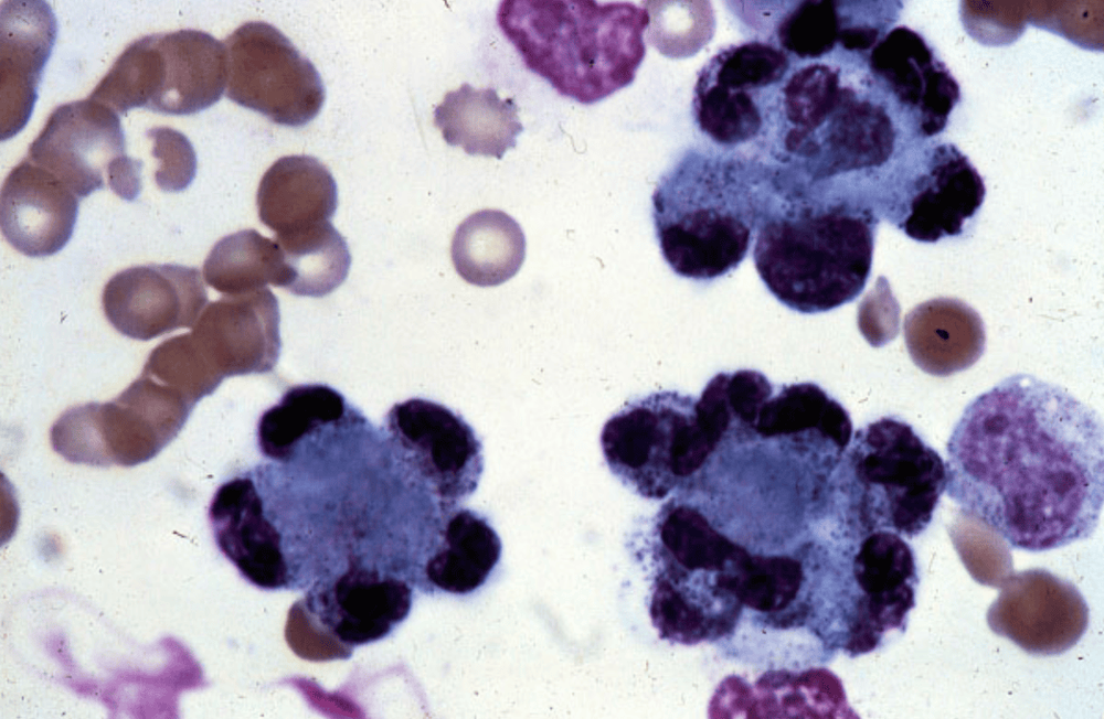 Xét nghiệm tế bào LE chẩn đoán bệnh Lupus ban đỏ hệ thống