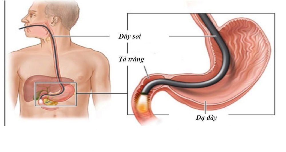 Bệnh nhân nên kiểm tra tình trạng giãn tĩnh mạch thực quản bằng nội soi sau khi có chẩn đoán xơ gan