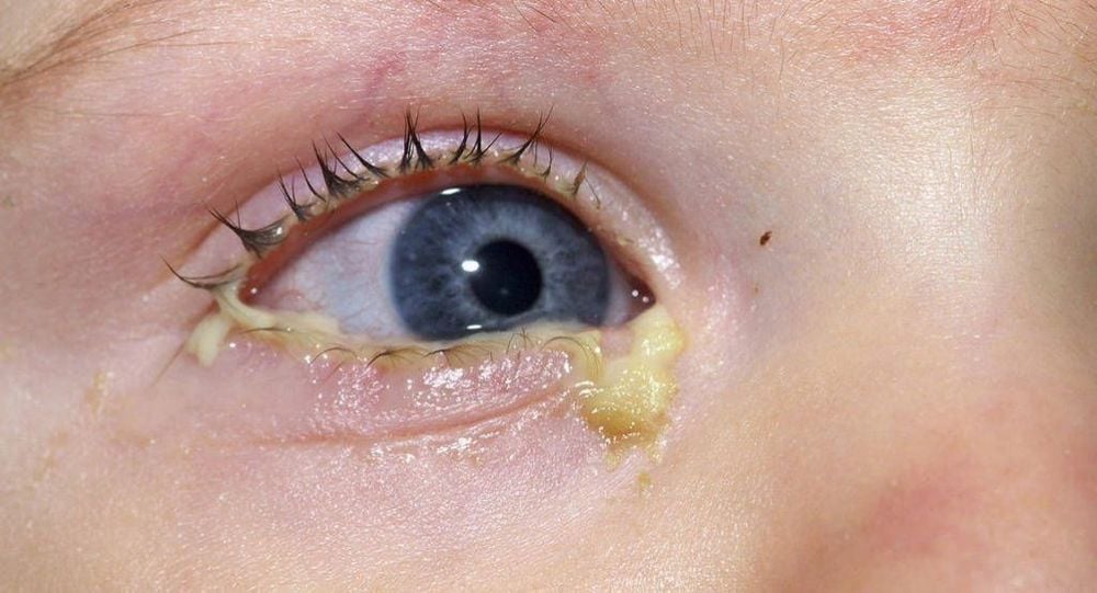 Conjunctivitis in neonates needs to be detected and treated early