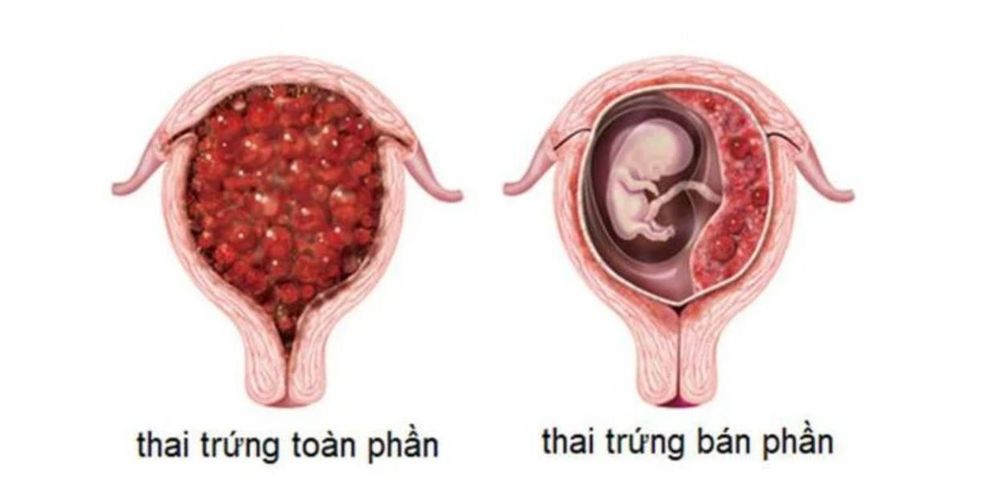 Hình ảnh chửa trứng hoàn toàn và chửa trứng một phần