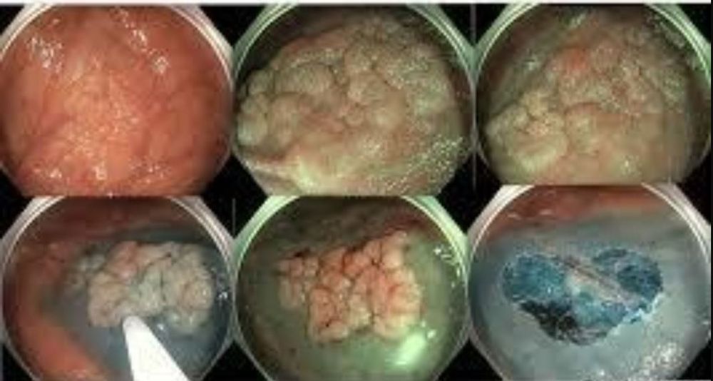 
Kỹ thuật cắt niêm mạc qua nội soi điều trị polyp đại tràng
