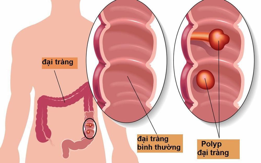 Số lượng polyp tuyến gia đình thường tăng lên theo tuổi và độ tuổi khởi phát ung thư đại trực tràng trung bình là 39