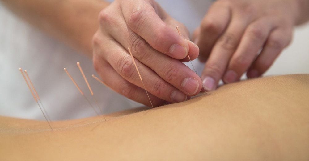 Châm cứu là một phương pháp y học cổ truyền của Trung Quốc có nguồn gốc từ hàng ngàn năm trước