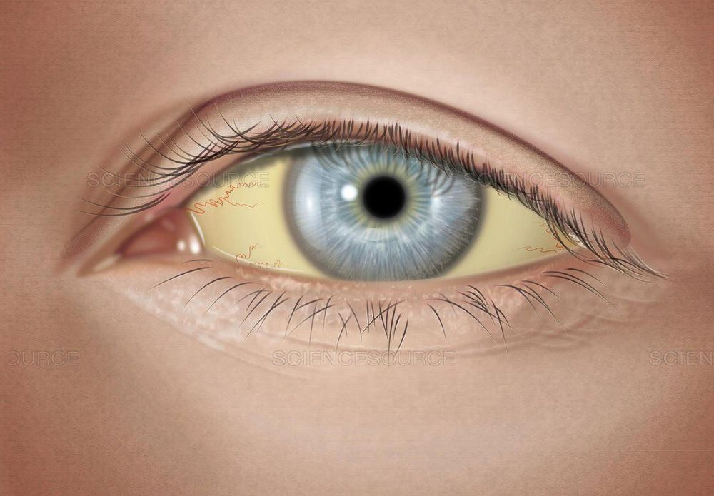 If you exhibit symptoms of jaundice of the eyes or skin while using Thiocolchicoside, contact a doctor immediately.