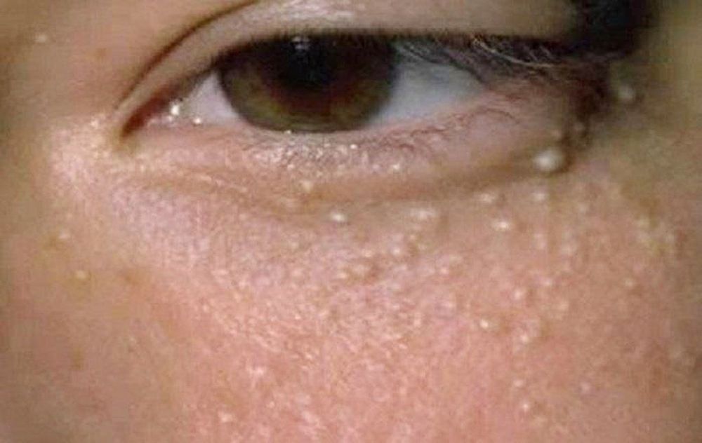 White bumps under the eyes may be milia
