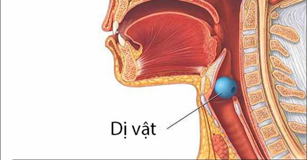 Dị vật đường thở là khi dị vật được hít vào và mắc kẹt trong đường thở hoặc phổi của bệnh nhân
