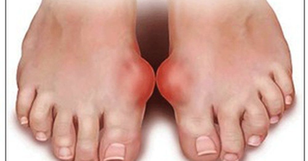 Bệnh gout cũng có thể là nguyên nhân gây ra các bệnh viêm khớp cổ chân.