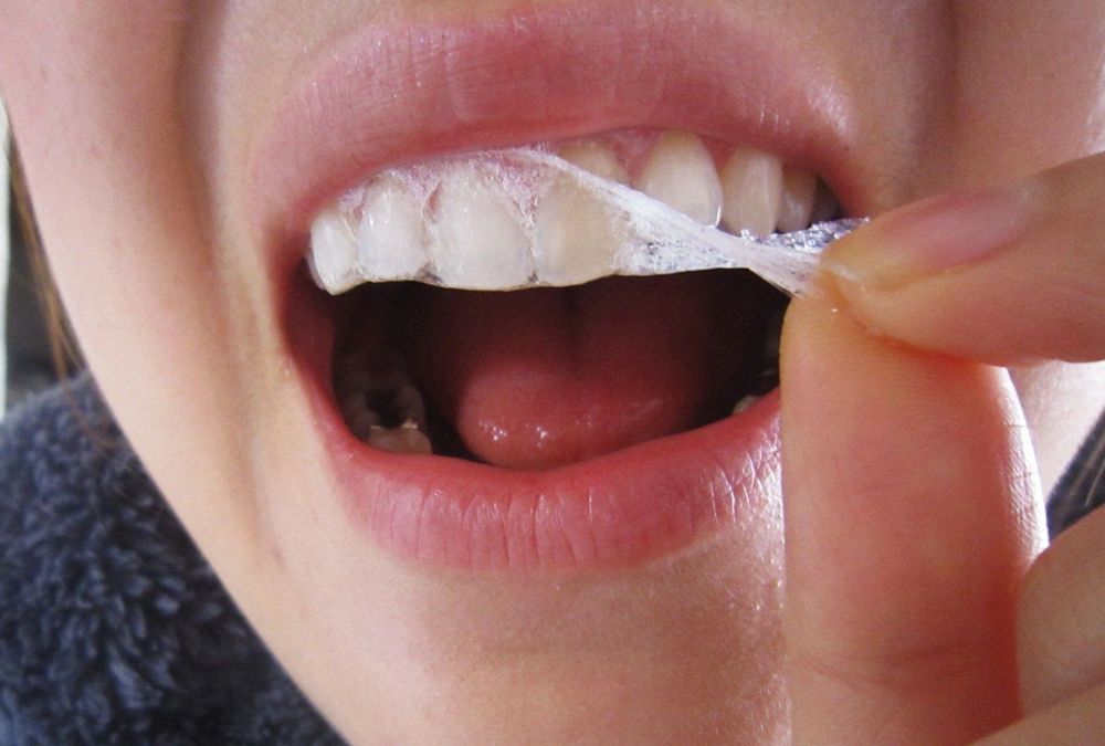 Miếng dán và gel là một trong các cách làm trắng răng tại nhà
