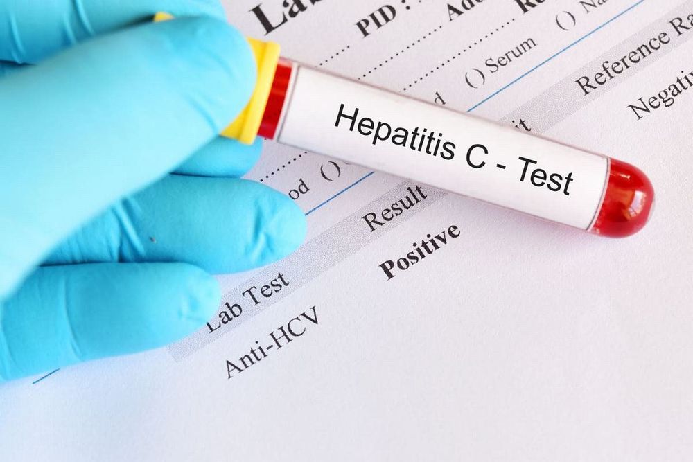 The HCV RNA test helps doctors accurately diagnose the disease.