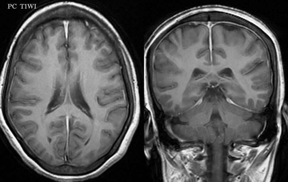 Hình ảnh người bệnh viêm màng não được chẩn đoán qua chụp CT, MRI