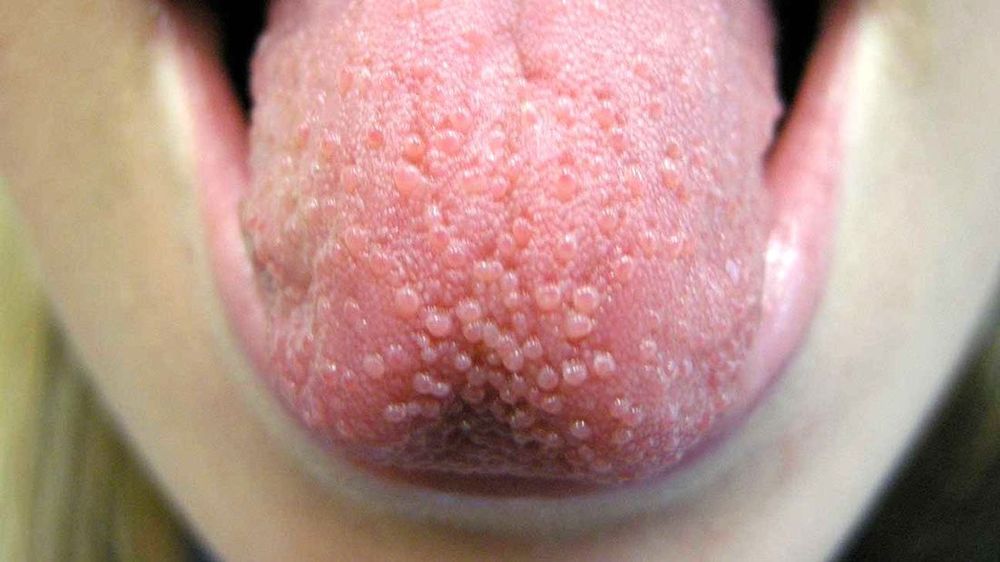 Bumps với các dấu hiệu u cục ở lưỡi người bệnh
