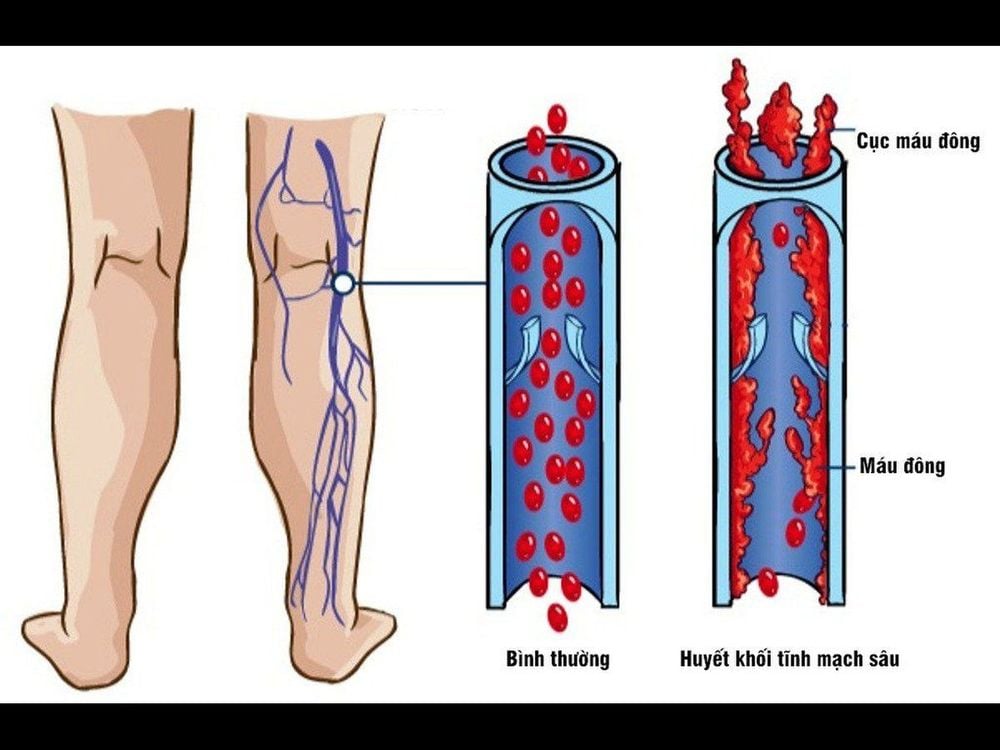 In the treatment of swollen veins in the hands, patients with deep vein thrombosis need to use anticoagulants.
