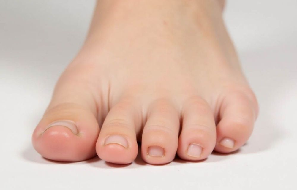 Có những trường hợp trật khớp ngón chân do dị tật bẩm sinh.