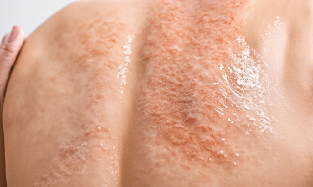 Dị ứng mỹ phẩm body thường gây ra tình trạng sưng đỏ, phồng rộp trên da.