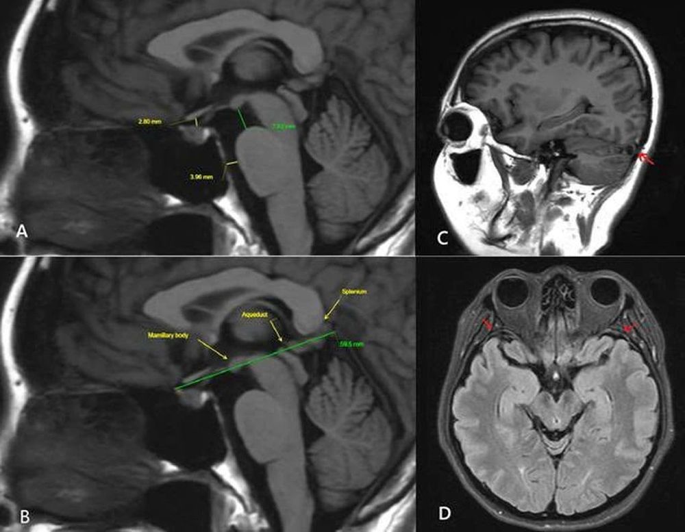 MRI sọ não lần 3 ghi nhận nhiều dấu hiệu gợi ý hội chứng giảm áp lực nội sọ do rò dịch não tủy