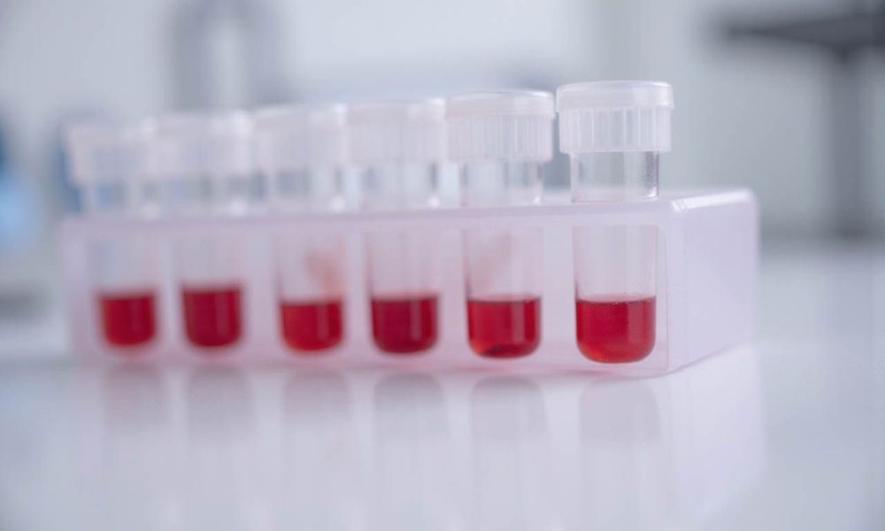 Quy trình sàng lọc Double Test gồm 2 phần là đo độ mờ cổ tử cung và xét nghiệm mẫu máu từ người mẹ