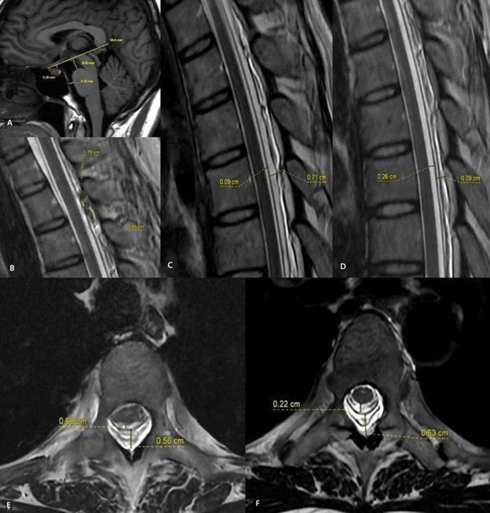 Hình ảnh MRI trước và sau thủ thuật vá máu ngoài màng cứng (EBP). Sau điều trị, khoang chứa dịch não tủy quanh tủy sống được mở rộng trở lại