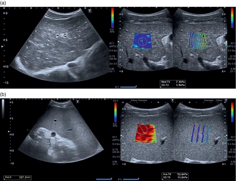 Elastography result