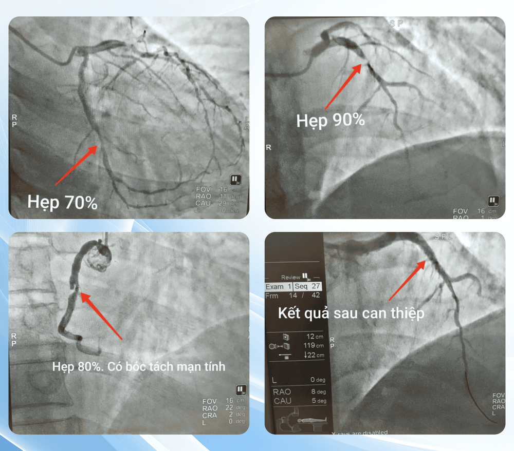 Ảnh chụp X-quang động mạch vành trước và sau can thiệp của bệnh nhân