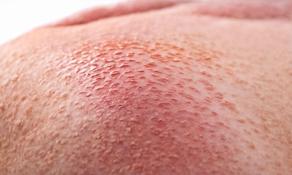 Bà bầu bị dị ứng ngứa phải làm sao là câu hỏi được nhiều phụ nữ quan tâm.