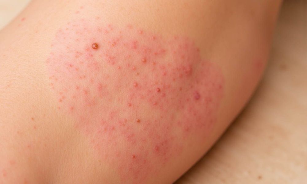 Việc xác định chế độ ăn có liên quan đến bệnh chàm không rất khó do còn nhiều yếu tố khác tác động.