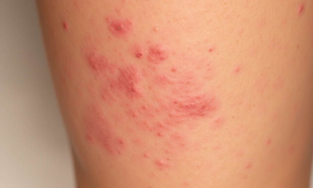 Bệnh chàm hay còn gọi là viêm da dị ứng, là một tình trạng viêm da mãn tính gây ngứa ngáy, khó chịu.