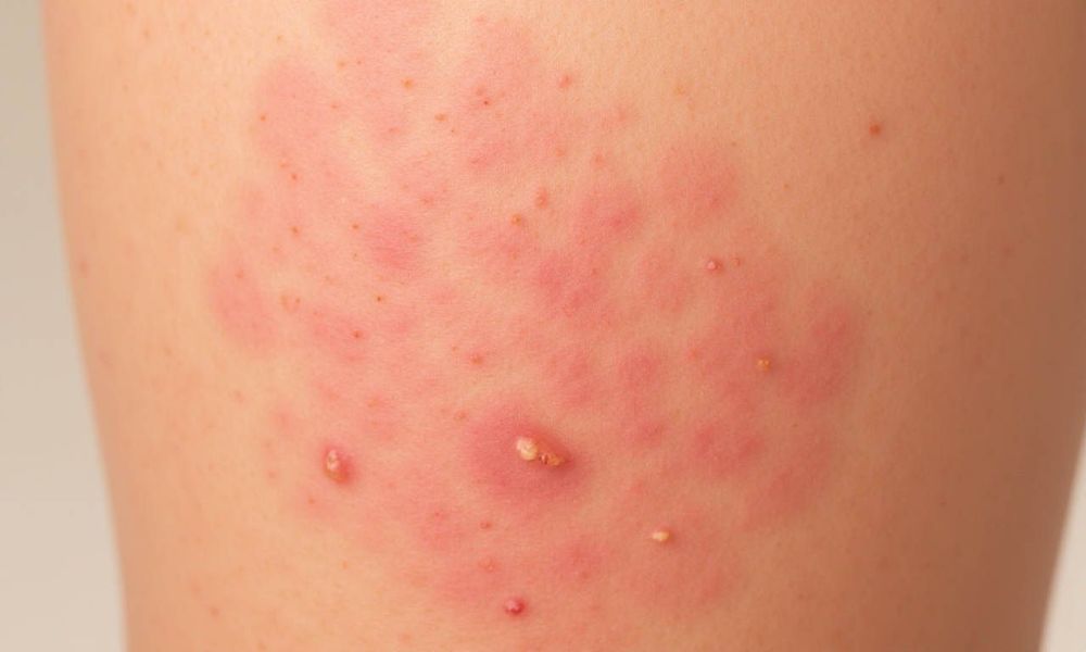 Bệnh chàm còn gọi là viêm da dị ứng do sự tác động của nhiều yếu tố.